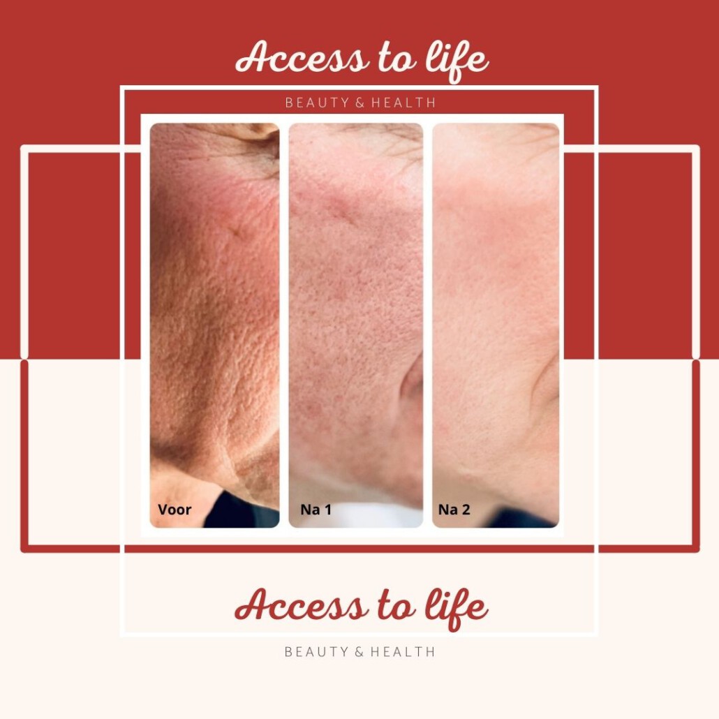 Access to life RF + HIFU Ultrasound na een Behandeling